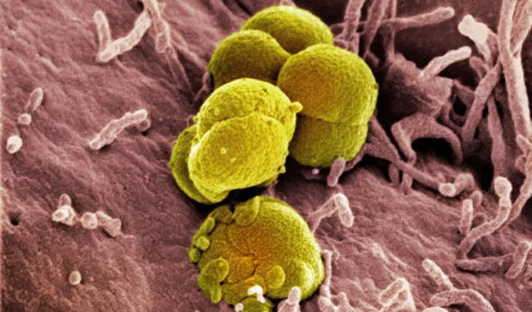 Gonorrea