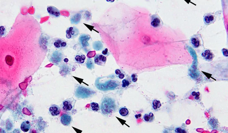 Tricomonas